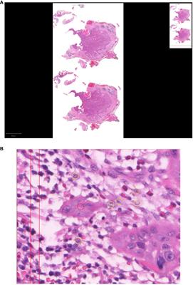 Tumor budding - a potential biomarker in low grade salivary gland carcinomas?